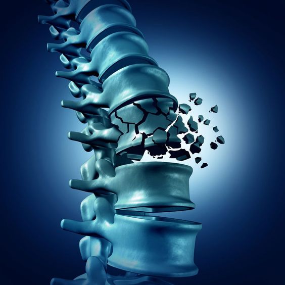 Osteoporosis: Symptoms, Causes, Tests & Treatment